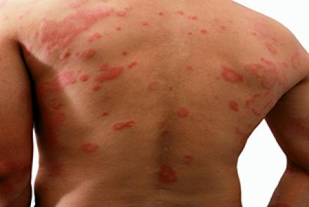 Back of a person with skin rashes