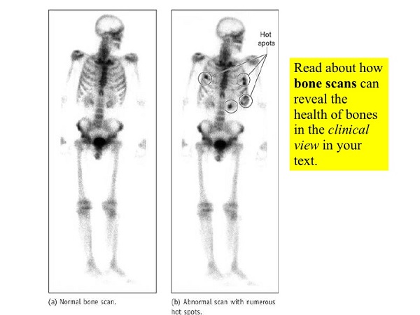 Normal Bone Scan