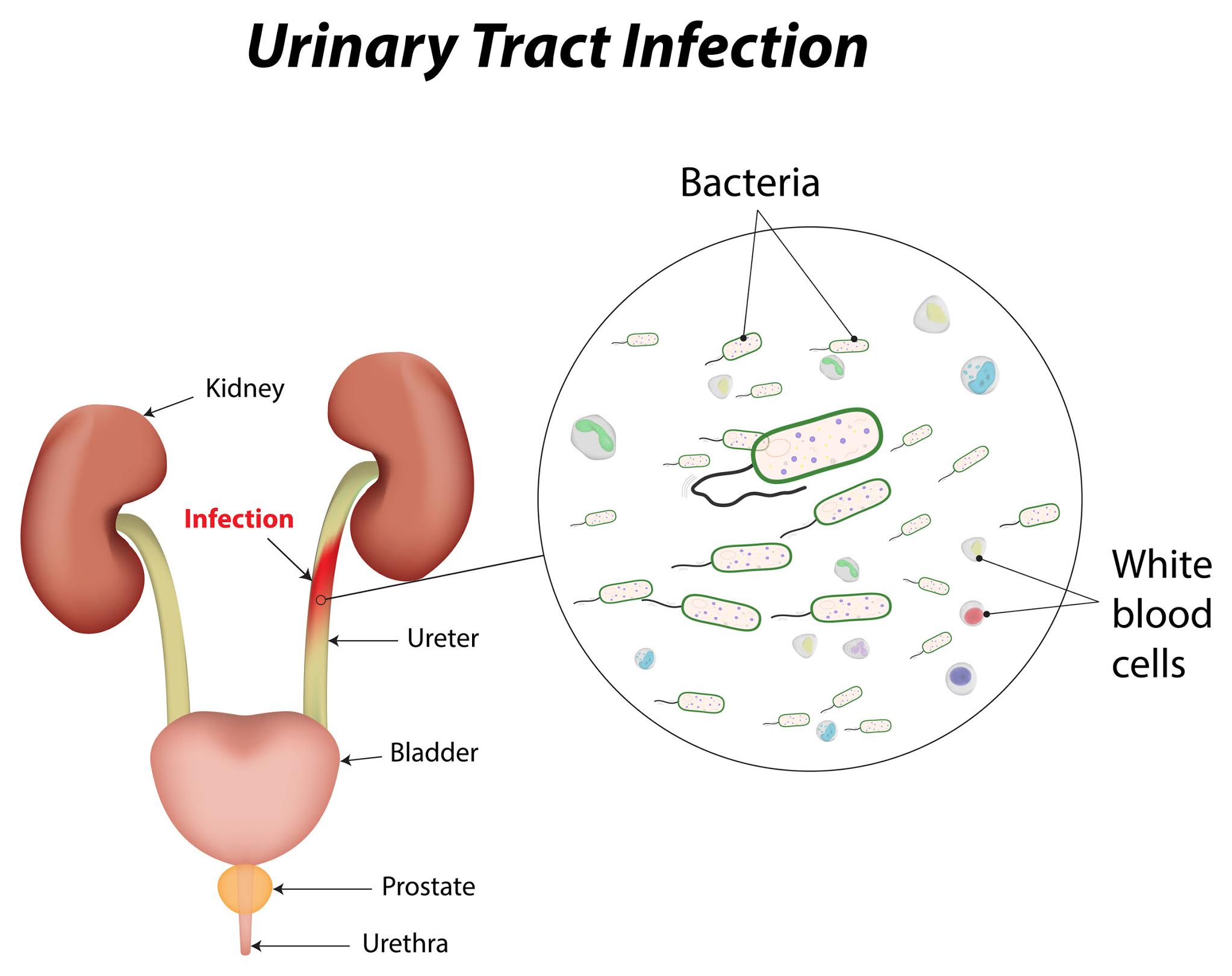 Urinary Tract Infection (UTI): Symptoms, Diagnosis & Treatment