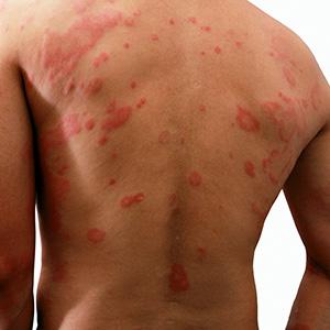 FAQ on Skin Allergies
