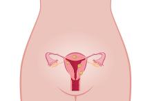 Diagram of a woman's reproductive system