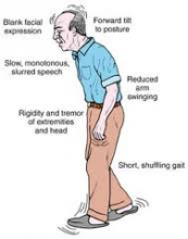 Parkinson's Disease - The Shaking Palsy | PatientsEngage