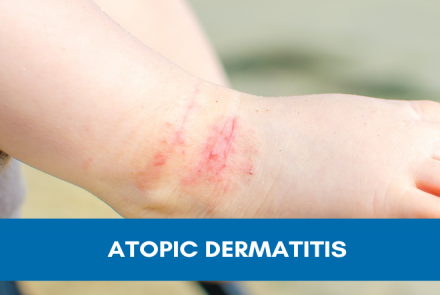 Types and Stages of Atopic Dermatitis, Types of Eczema