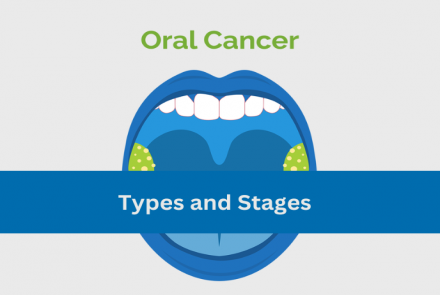 Oral Cancer Types and Stages