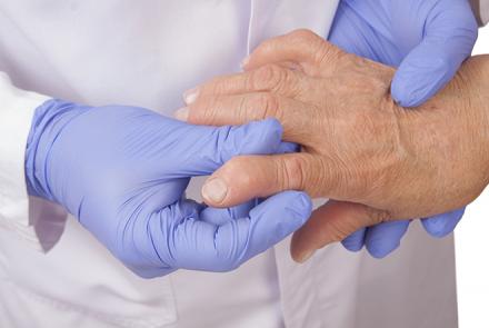 The hands of a medical professional in a white coat and blue gloves examining the deformed hand of a patient with rheumatoid arthritis