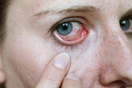 redness and dryness in eye